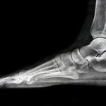 Do I Need An X-ray? Simple Ankle And Foot Rules
