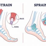 The Difference Between A Sprain And A Strain