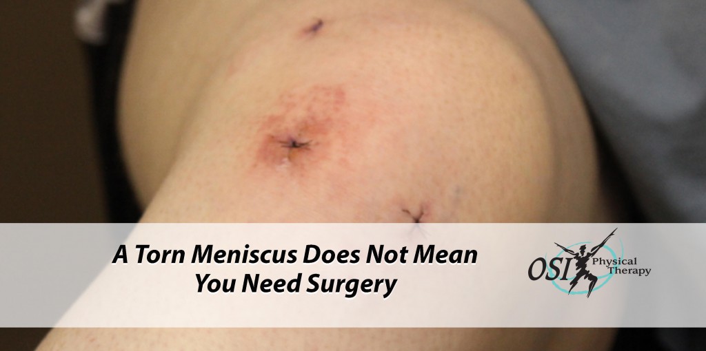 A Torn Meniscus Does Not Mean You Need Surgery